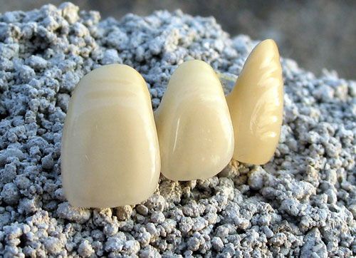 贵金属假牙(贵金属假牙多少钱一颗)