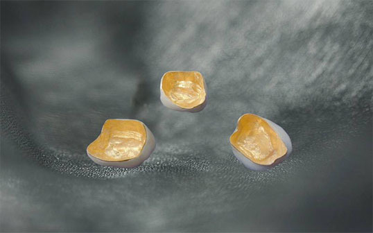 贵金属牙图片(贵金属假牙具体是一些什么材料)