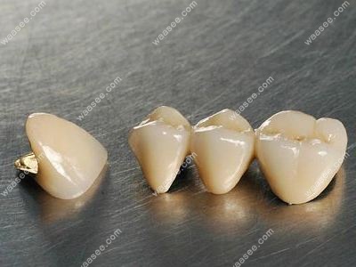 半贵金属烤瓷牙价格(半贵金属烤瓷牙多少钱)