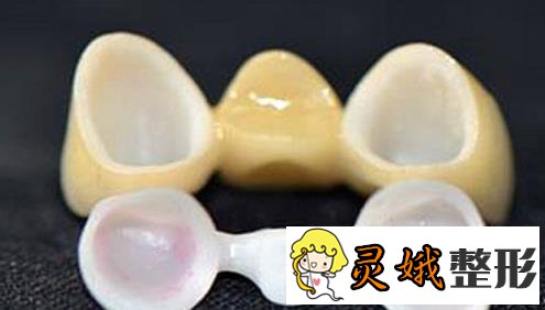 半贵金属烤瓷牙价格(半金属烤瓷牙和全瓷牙的区别)