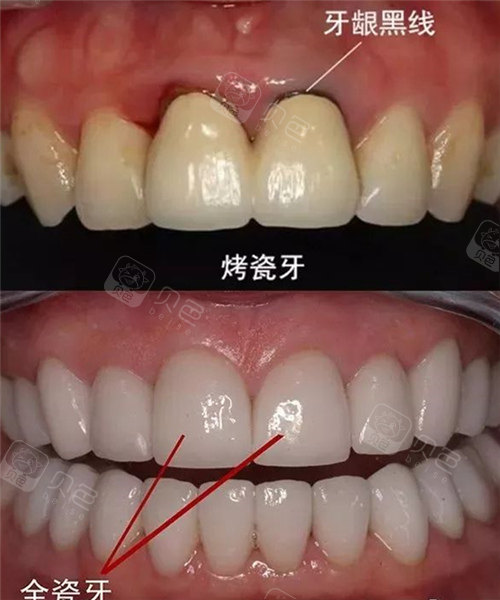 半贵金属烤瓷牙价格(半金属烤瓷牙和全瓷牙的区别)