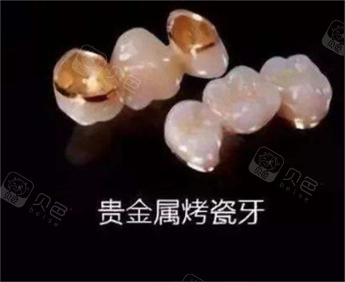 贵金属牙图片(贵金属牙什么材料)